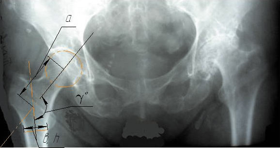 Рис. 1. Рентгенограмма тазобедренного сустава. Интересующие нас размеры: ? — угол наклона оси головки относительно ножки бедренной кости, а — расстояние от центра головки до оси ножки, измеренное по линии наклона головки, в и h — толщина и ширина основания ножки эндопротеза соответственно