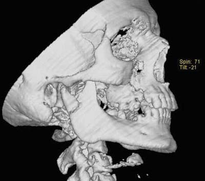 Рис. 2. Компьютерная томография нижний челюсти