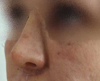 Рис. 17. Фотография пациентки с установленным протезом носа (без макияжа)