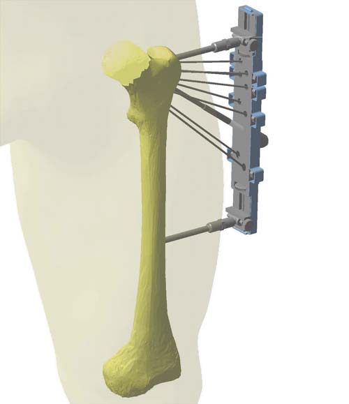 Рис. 2. Моделирование на стадии предоперационного планирования, устройство для лечения переломов проксимального отдела бедренной кости